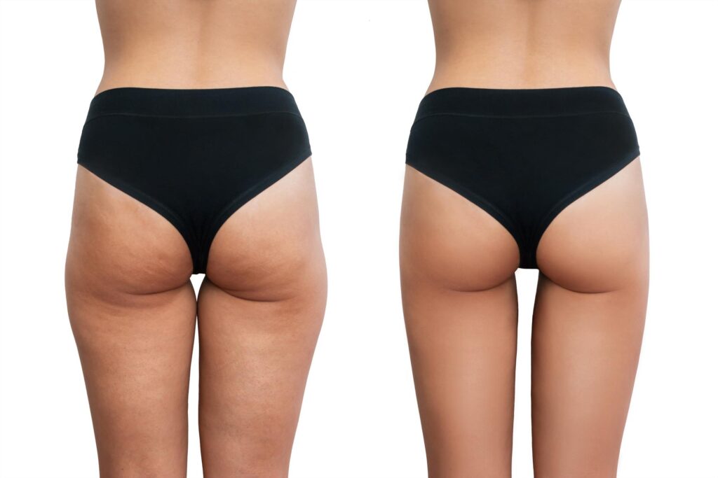 cooltone-before-and-after-hip-booty